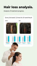 Hair loss analysis. Analysis of treatment progress. The image shows a sample of before and after of hair growth. It reads; (Every 2nd week) 12 times for 24-week result. It then shows graphs of before and after hair volume, thickness, hairs per follicle, and a total score. There is also an image of the scalp scan being performed on someone. 